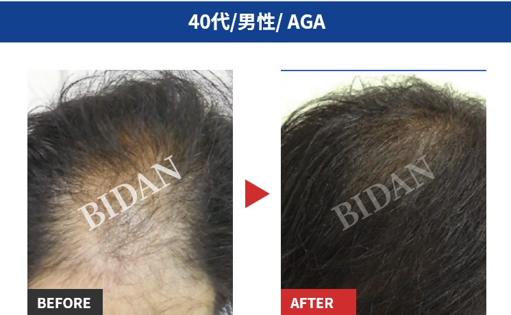発毛サロンbidan